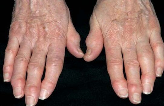 Arthrose van de handen