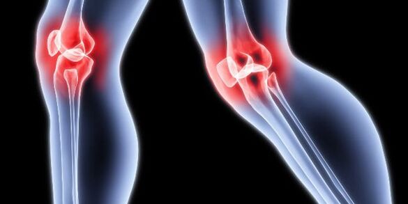 Arthrose van de knie