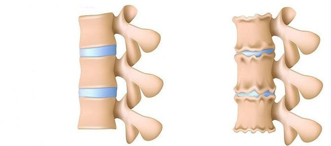 Wat is osteochondrose