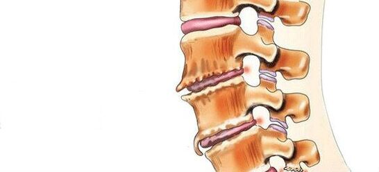 Wat is spondylose