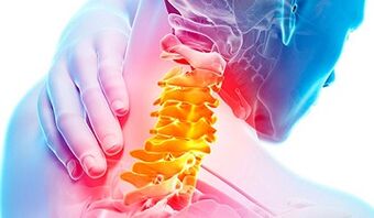 Tekenen van osteochondrose van de cervicale wervelkolom