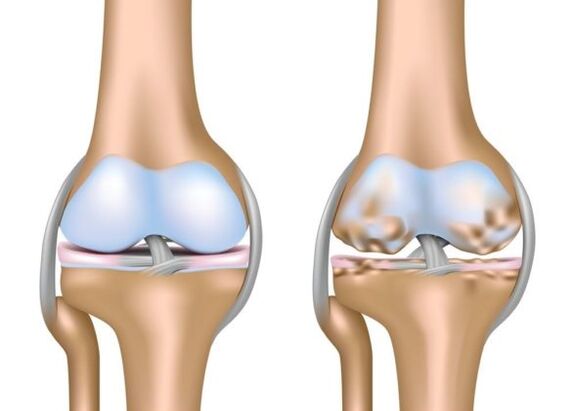 Wat is gonarthrose