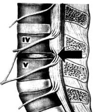 X -Ray foto van het lumbale ministerie van osteochondrose