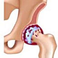 Arthrose van het heupgewricht