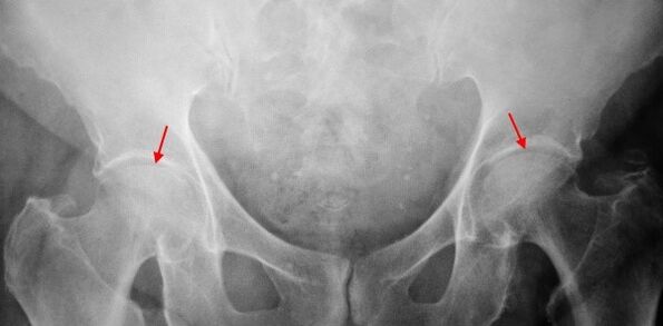 Dubbelzijdige coksartrose-timing van de gewrichtspleet, sclerose van de gewrichtsoppervlakken