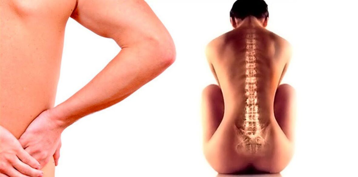 lage rugpijn als gevolg van osteochondrose
