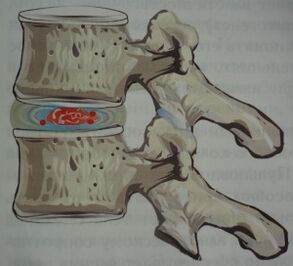 Eerste fase van osteochondrose