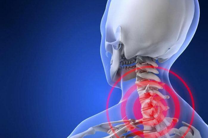 Pijn in de nek schieten is een vroeg symptoom van cervicale osteochondrose