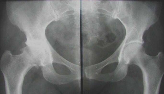 röntgenfoto van het aangetaste heupgewricht met artrose